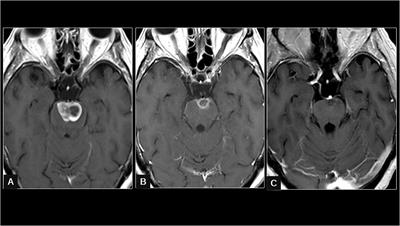 Sacituzumab govitecan response in extensive leptomeningeal carcinomatosis from triple-negative breast cancer: a case report